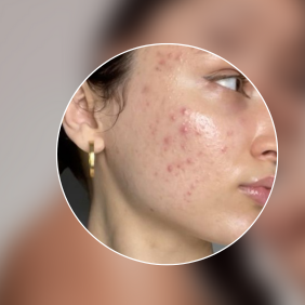 Skin Type